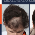 The Long-Lasting Results of Exosome Hair Therapy