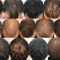 Is exosome therapy safe for hair?