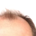 Which hair loss treatment is permanent?