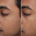 When will i see results from microneedling with exosomes?