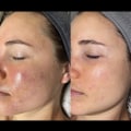 How long does it take to see results from microneedling with exosomes?