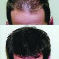 The Long-Term Benefits of Exosome Therapy for Hair Loss