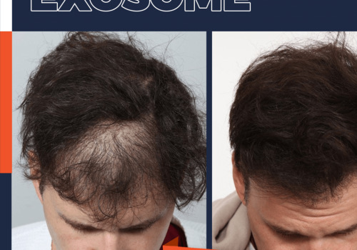 The Long-Lasting Results of Exosome Hair Therapy