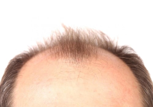 Which hair loss treatment is permanent?