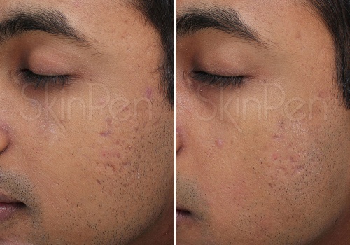 When will i see results from microneedling with exosomes?