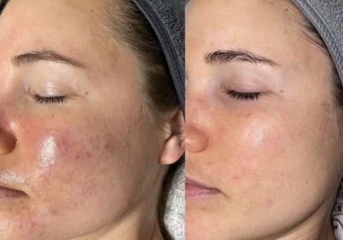 How long does it take to see results from microneedling with exosomes?