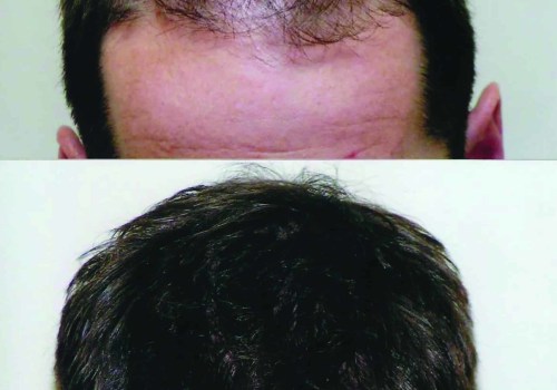 The Long-Term Benefits of Exosome Therapy for Hair Loss